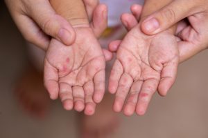 vésicules en navettes, caractéristiques du syndrome pied main bouche