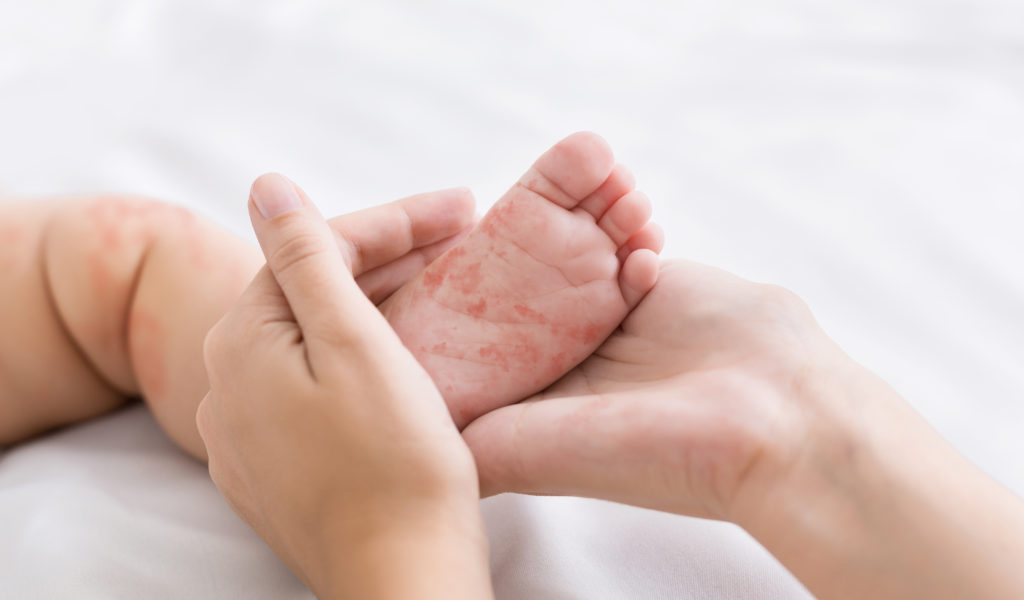 Le Pied Main Bouche: Une Maladie Enfantine à Connaître