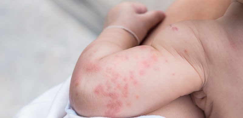 Peau de bébé : problèmes et maladies de peau chez l'enfant - mpedia.fr