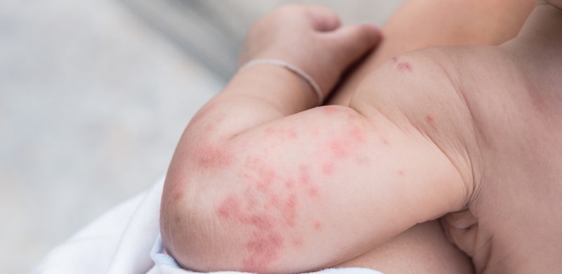 Peau De Bebe Problemes Et Maladies De Peau Chez L Enfant Mpedia Fr