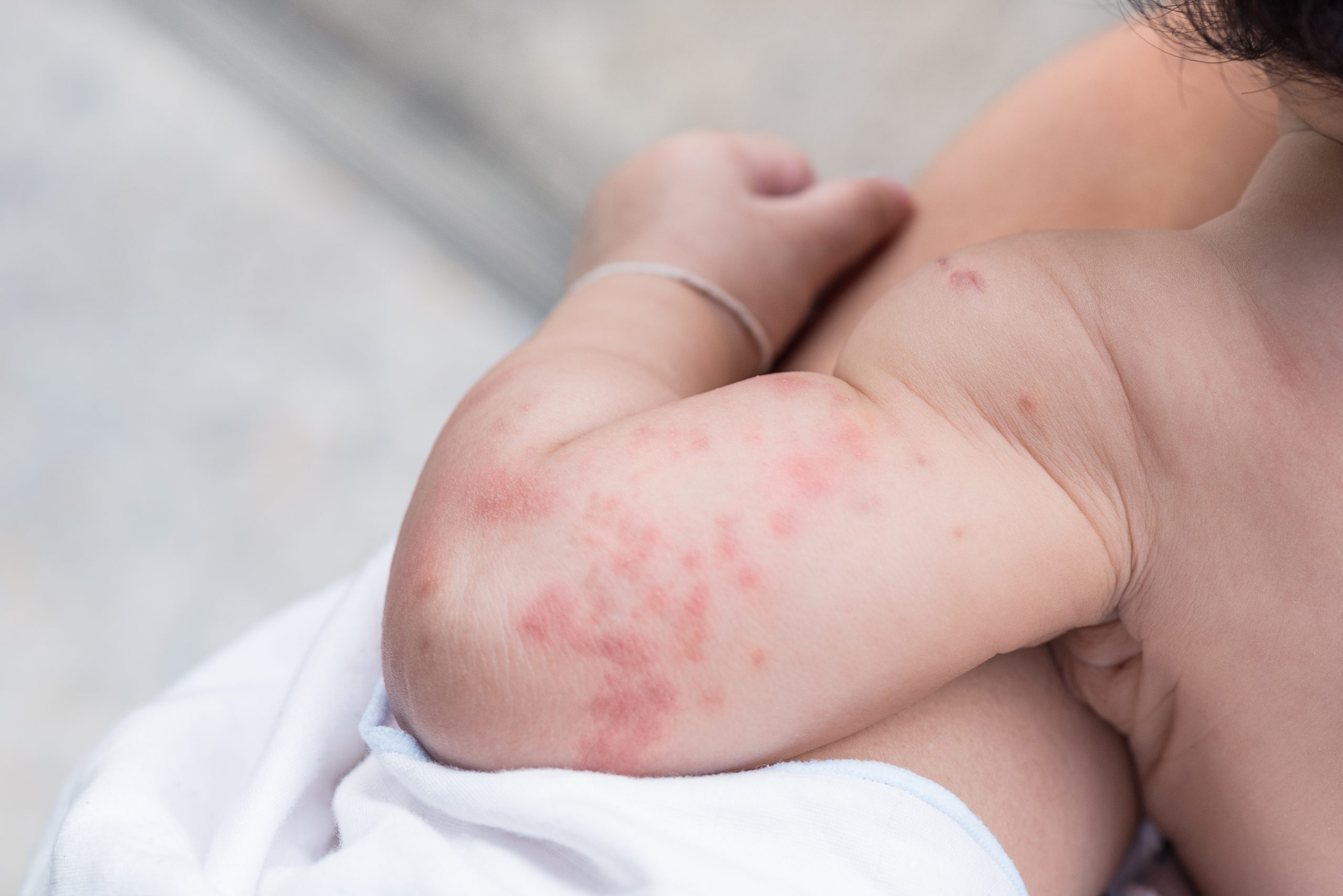 Peau De Bebe Problemes Et Maladies De Peau Chez L Enfant Mpedia Fr