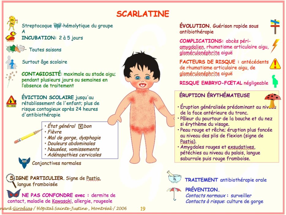 La Scarlatine Définition Symptômes Et Traitement Mpediafr