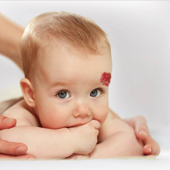 L Hemangiome Infantile Le Detecter Le Soigner Mpedia Fr