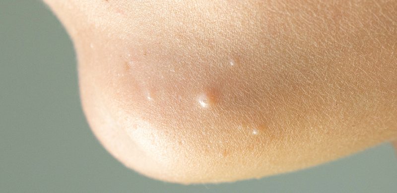 Photographie d'un molluscum contagiosum sur le menton d'un enfant.