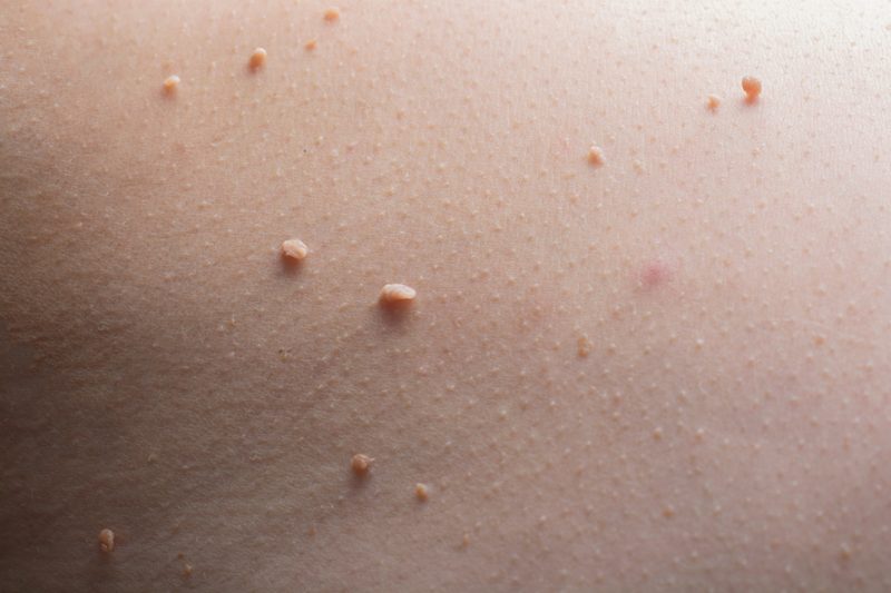 Photographie de molluscums pendulums, à ne pas confondre avec le molluscum conagiosum (infection).