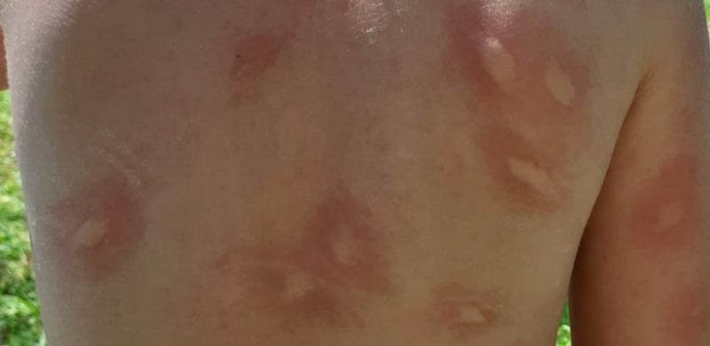 Photographie d'un dos d'un enfant piqué par des moustiques