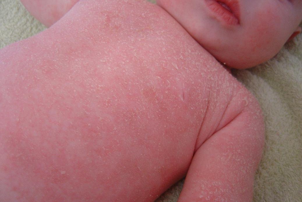 Peau Seche Rougeurs Allergies L Eczema Mpedia Fr